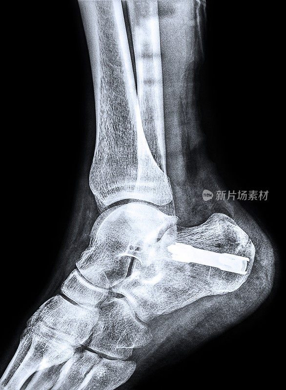 跟骨骨折后脚跟的x光片