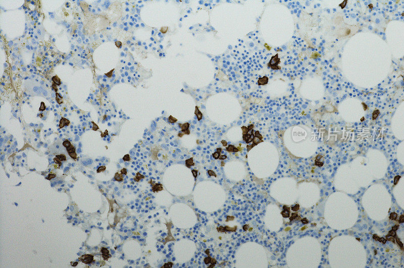 浆细胞肿瘤的显微照片。应用CD138
