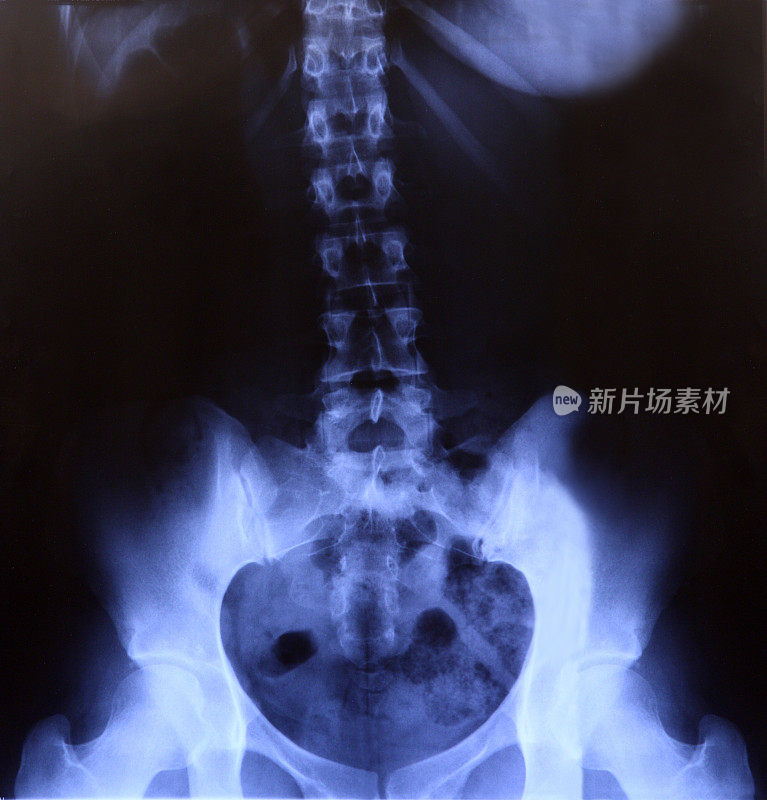 髋部及脊柱x光片