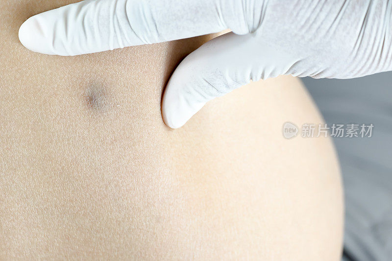 囊肿消退后妇女背部皮脂腺的医生诊断