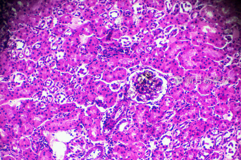 显微镜下急性肾盂肾炎活检标本