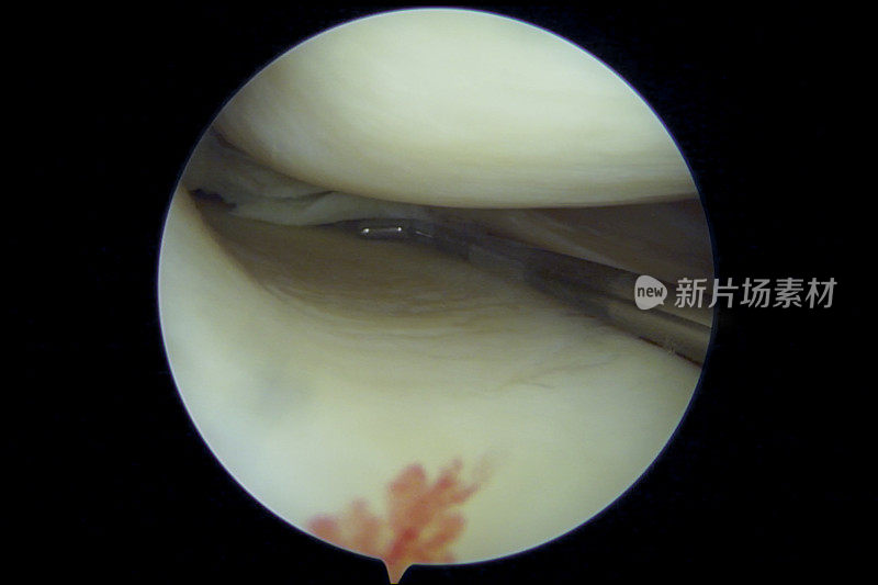 内侧半月板后部复杂退行性撕裂的人类膝关节关节镜视图
