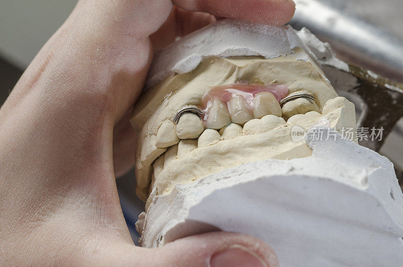 牙科技师用丙烯酸树脂做局部假牙。