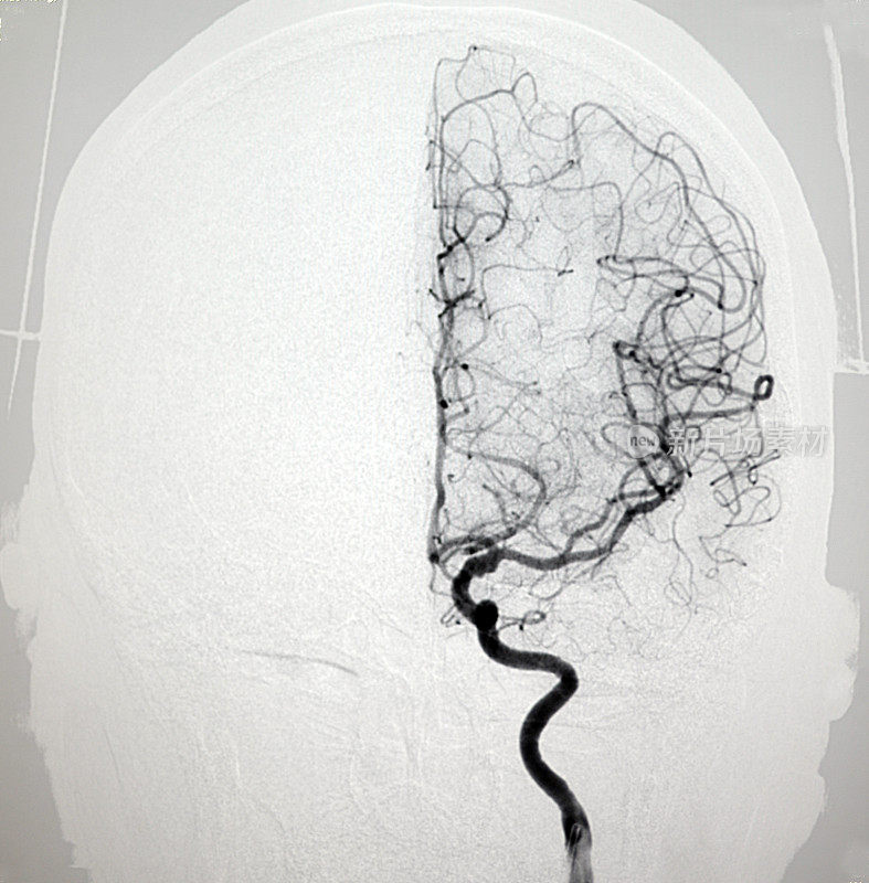 颈内动脉DSA图像