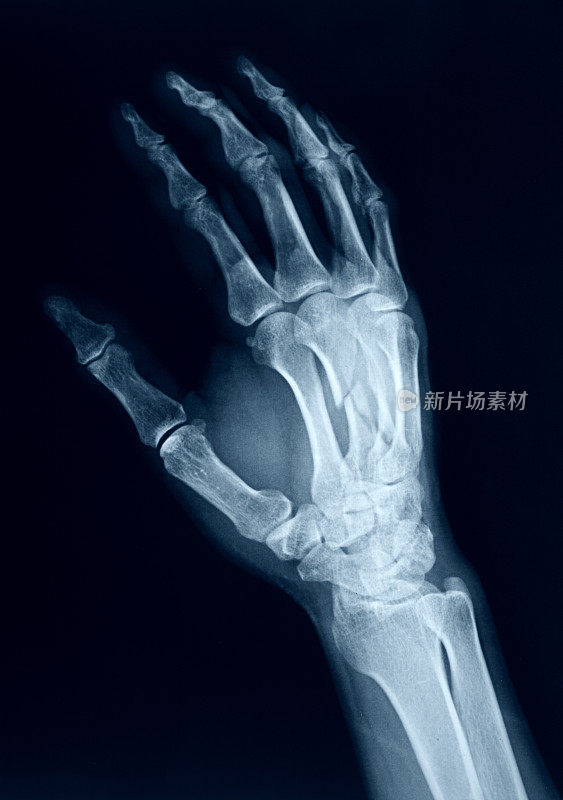 x射线图像的手