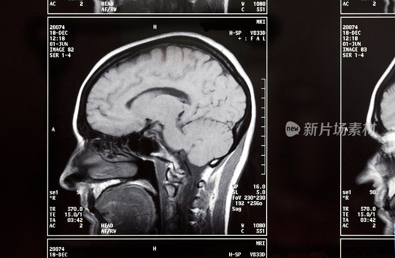 脑部核磁共振电影