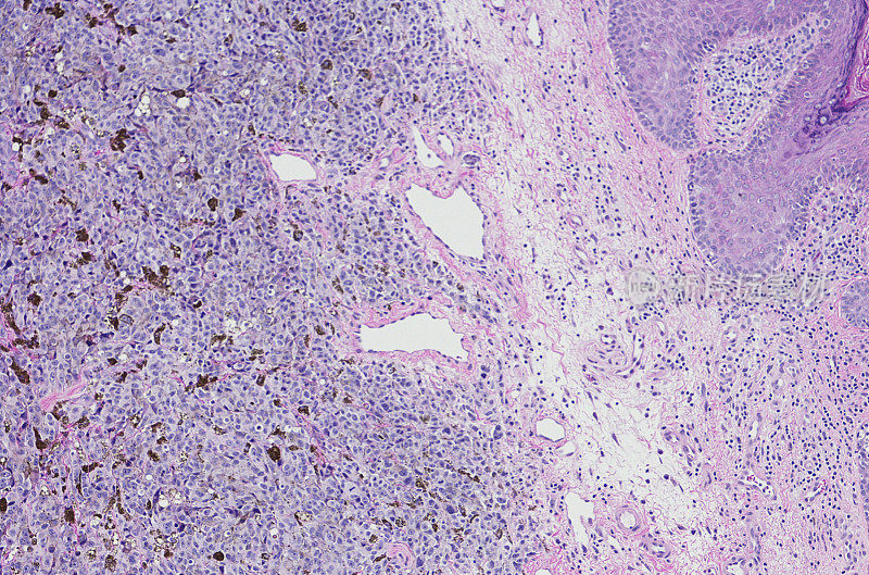 外阴恶性黑色素瘤显微照片。