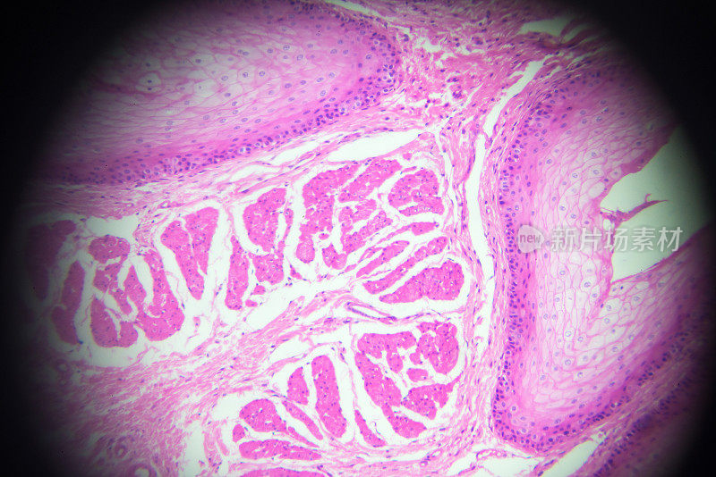 显微镜下呈层状鳞状上皮