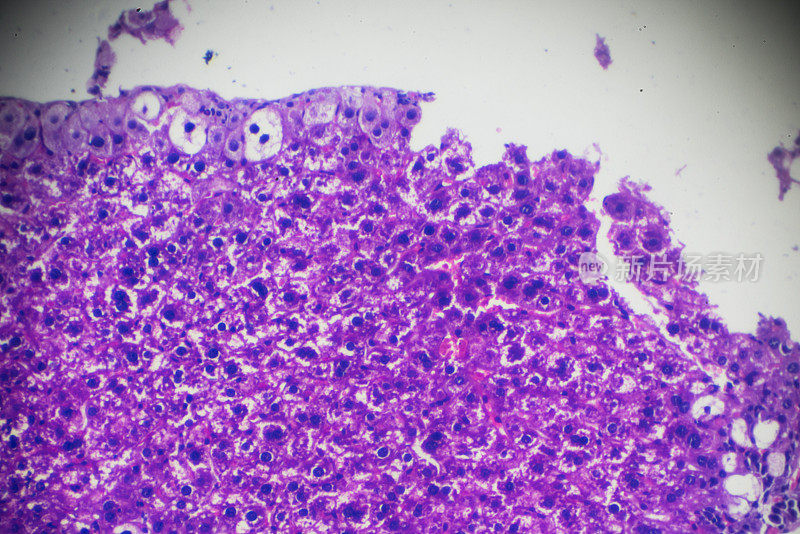 光镜下急性普通肝炎肝活检