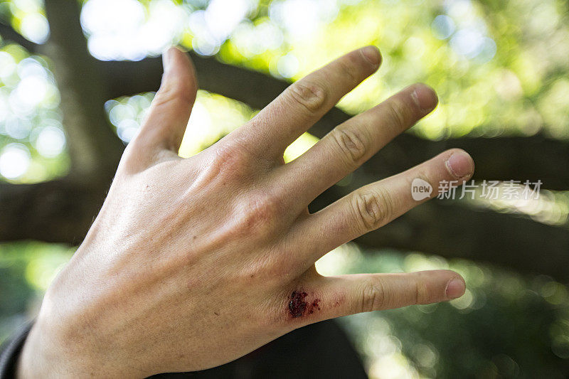 年轻成年男子受伤的指关节的特写