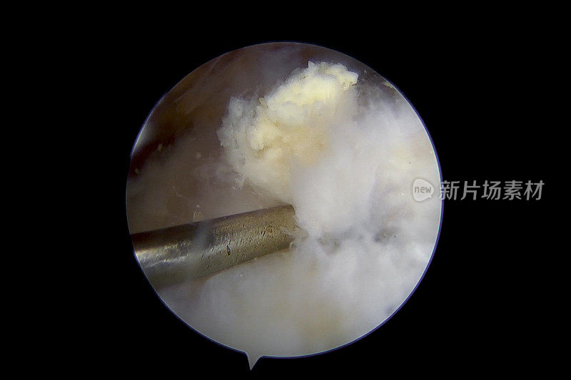 关节镜下冈上肩肌腱钙沉积的清除