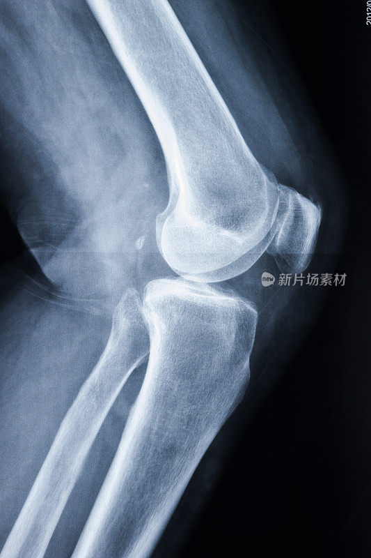 膝关节x线显示半月板骨折