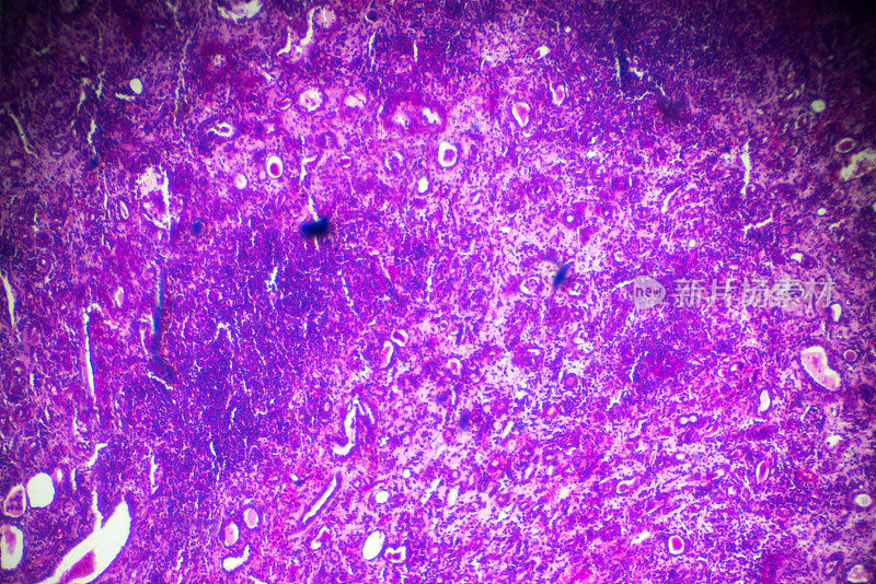 显微镜下硬化性肾小球肾炎活检标本