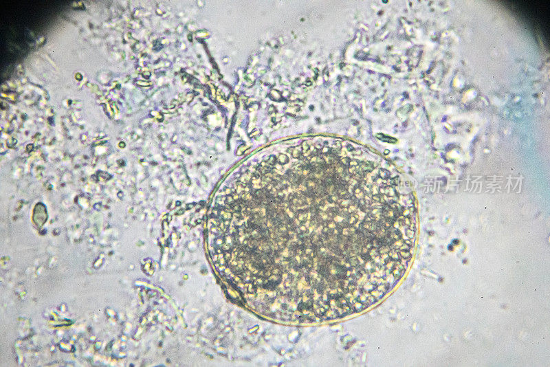 光镜下支气管吸虫卵
