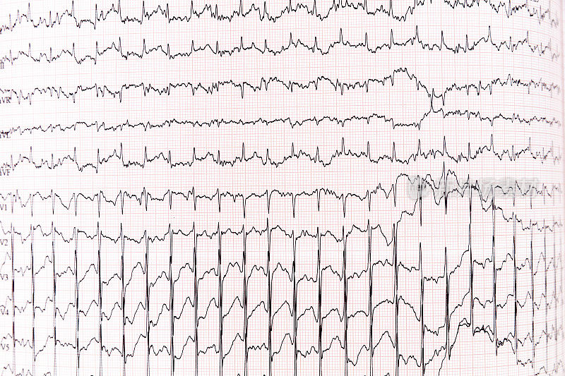 图表心电图(ECG)