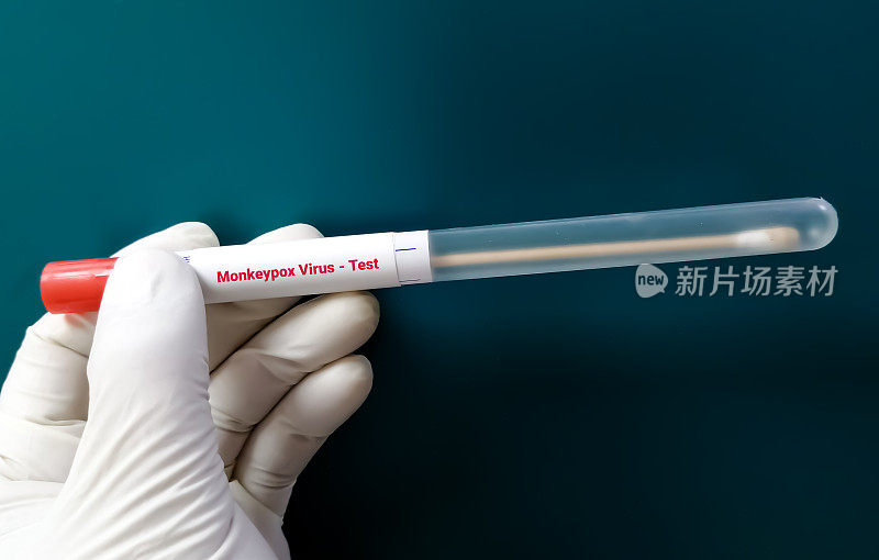 猴痘病毒测试的小泡液样本。它也被称为Moneypox病毒，一种双链DNA病毒和痘病毒科的成员。
