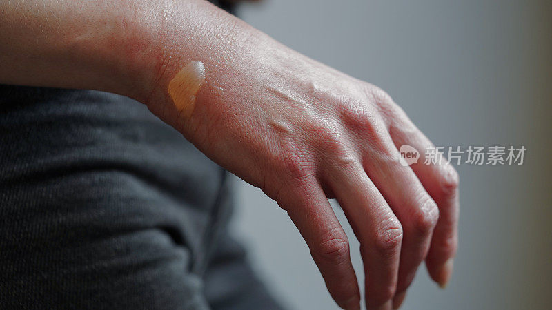 近距离的一个女人的手与水泡从开水烧伤，受损的皮肤，一级或二级烧伤。痛苦的伤口。热灼伤。烧伤后膀胱积水，治疗伤口。宏观照片