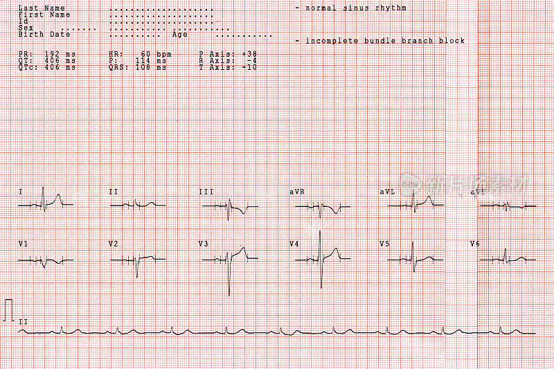 XL号病人的心电图