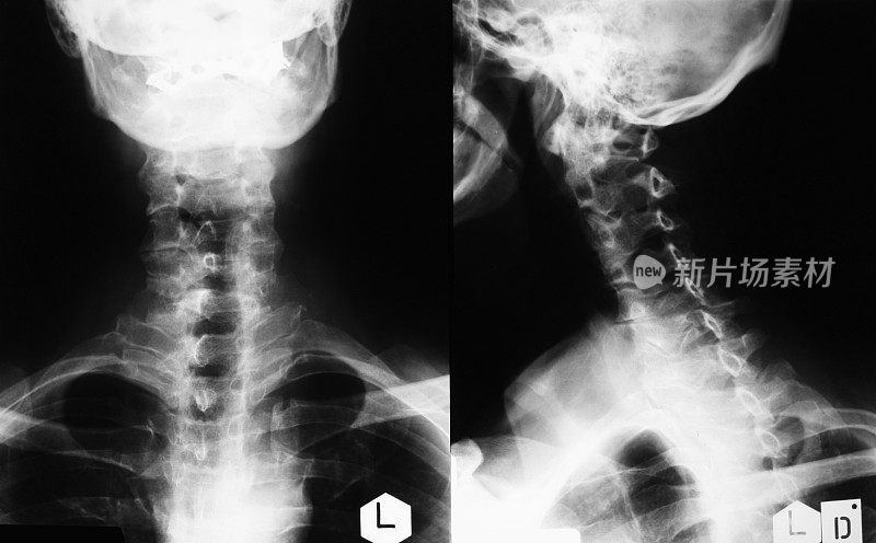人体颈部x光片，侧面和正面