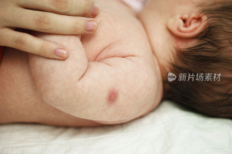 婴儿手部结核病疫苗