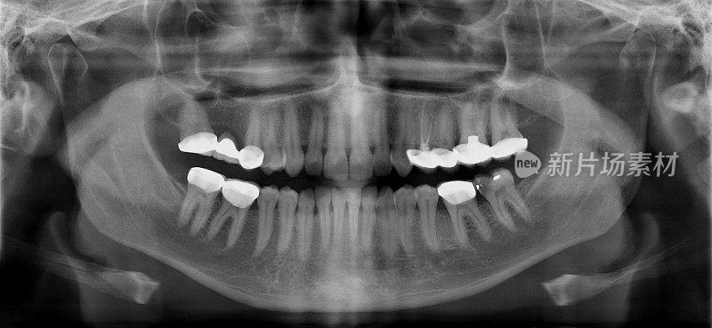 一名成年男性的牙科x光片