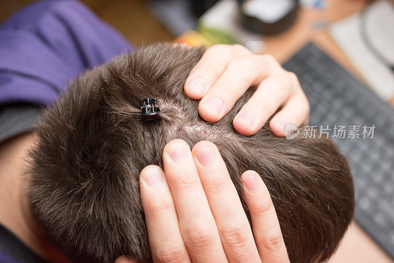猫爪造成的头皮损伤与人的头部微距拍摄