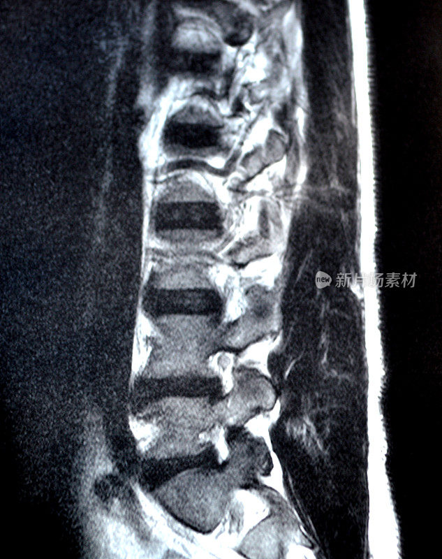 脊柱MRI扫描显示椎间盘突出