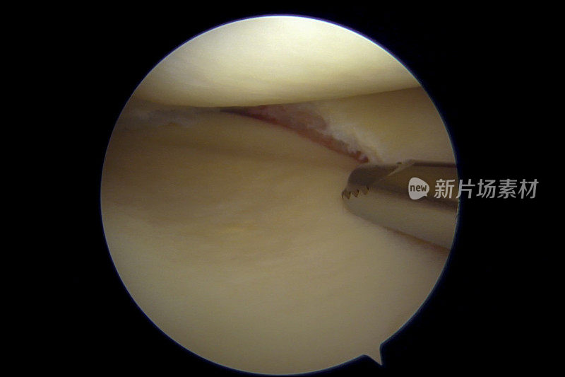 右膝内侧半月板后部皮瓣撕裂的关节镜观察