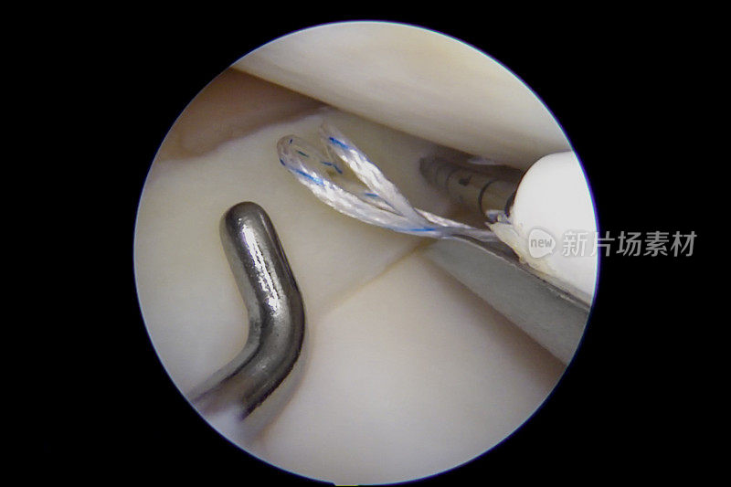 膝关节半月板全内修复的关节镜视图