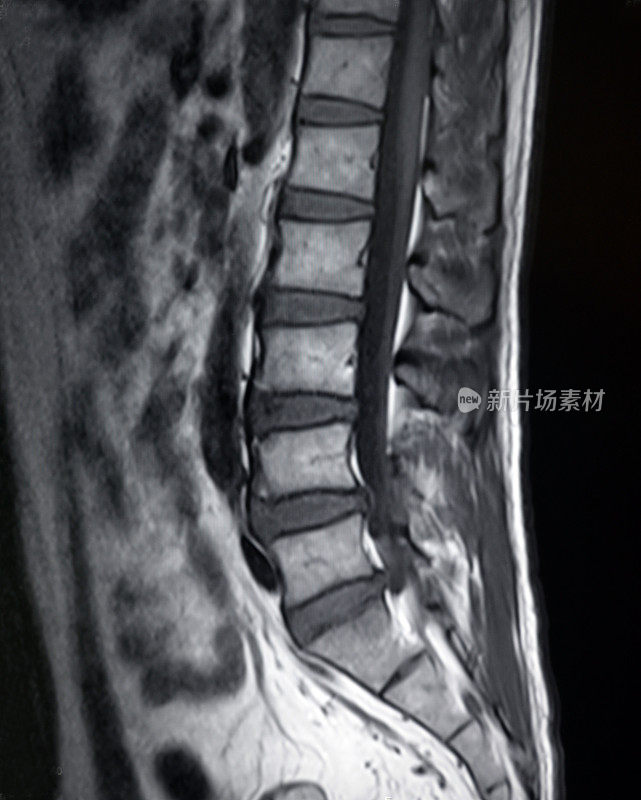 人体腰椎磁共振成像(MRI)