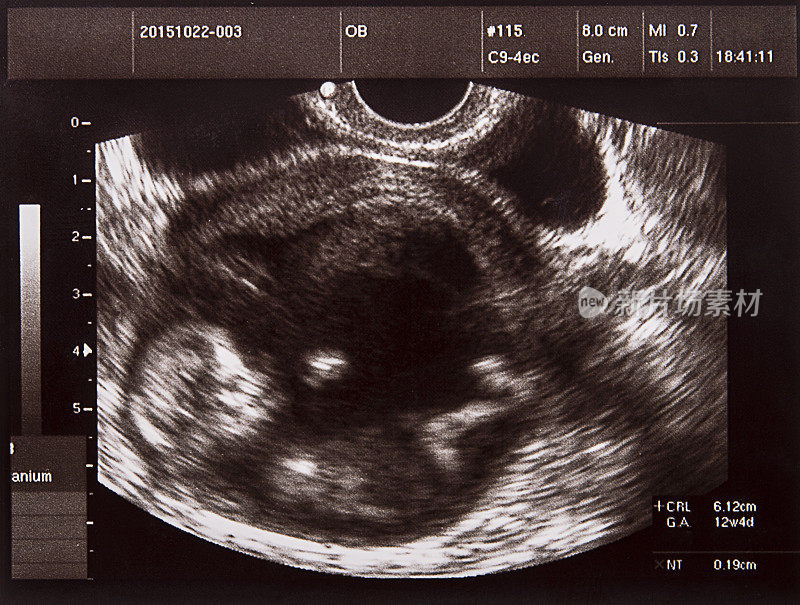 子宫里婴儿的超声波图像