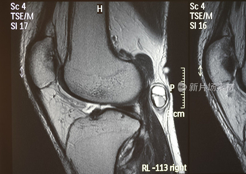 膝关节MRI矢状面显示神经肿瘤