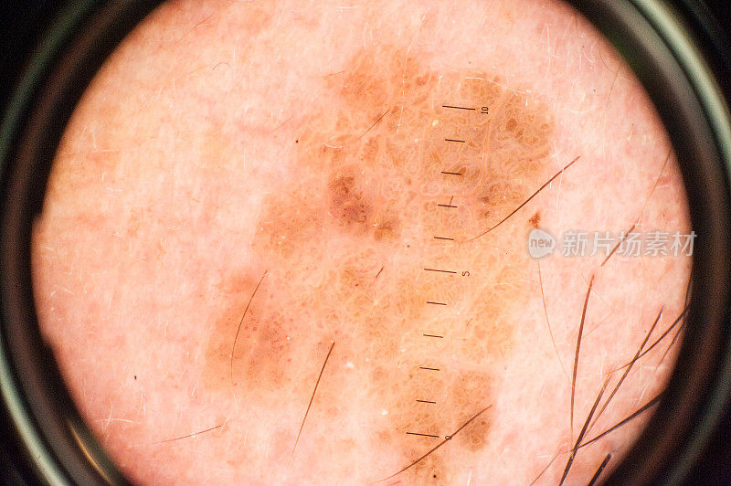 通过皮肤镜放大痣