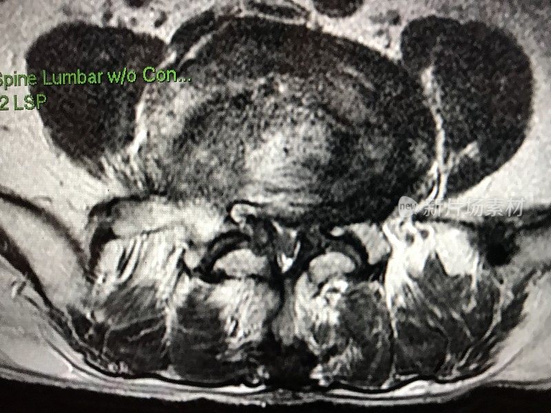 MRI检查显示严重腰椎管狭窄，轴向视图