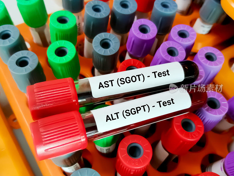 血样进行AST和ALT检测。肝功能测试。