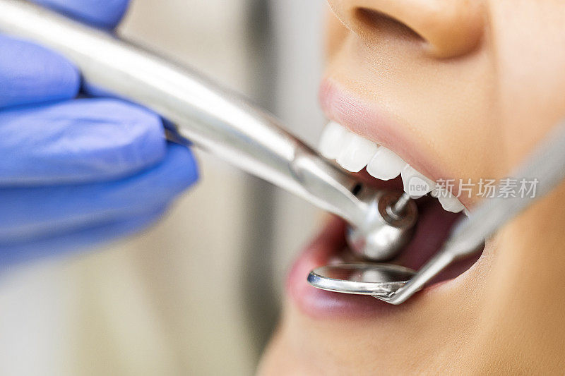 特写图像的妇女的嘴在牙医与牙钻