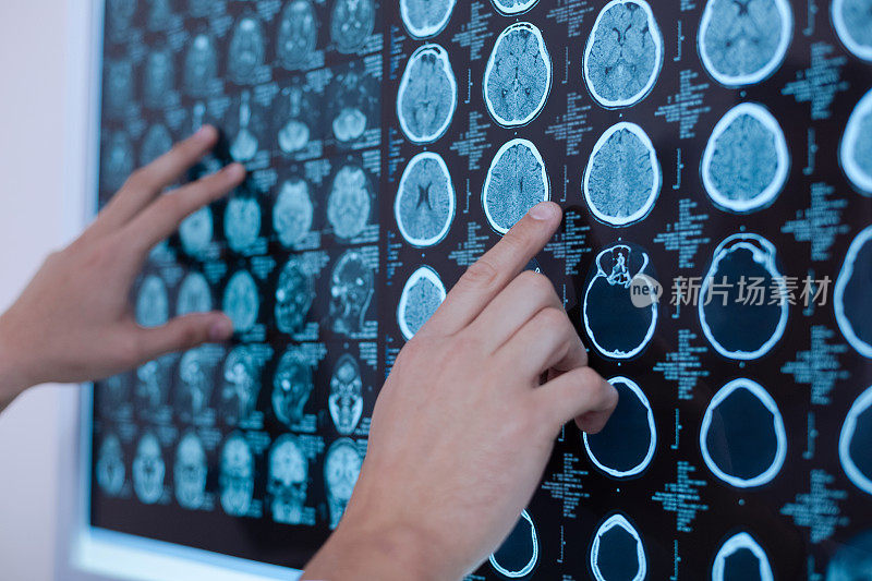 人类大脑的X光图像被放在白板上