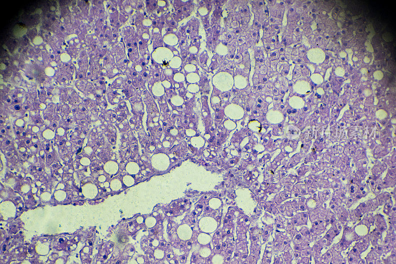 显微镜下肝脏脂肪变性