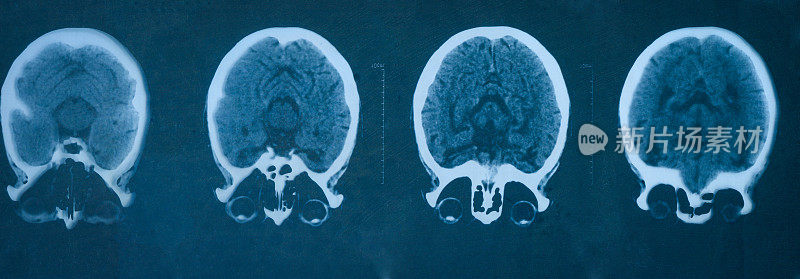 MRI扫描人类头部胶片