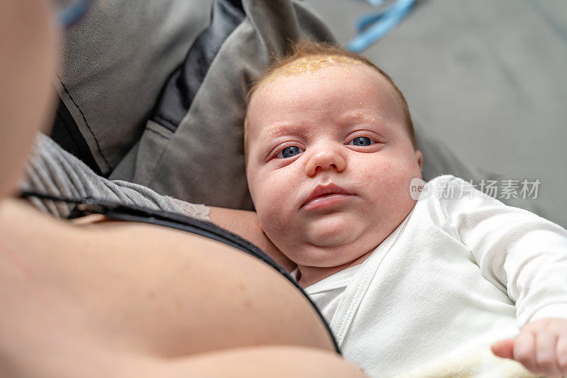 可爱的胖乎乎的婴儿头皮肤病摇篮帽脂溢性皮炎