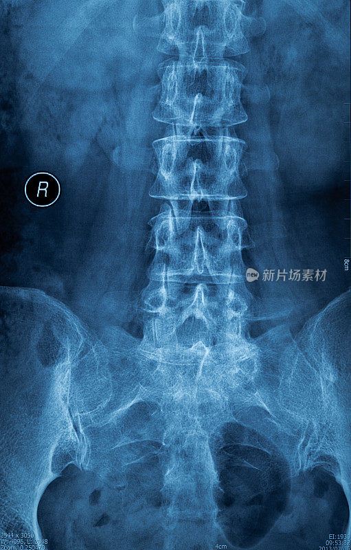 脊柱x射线胶片