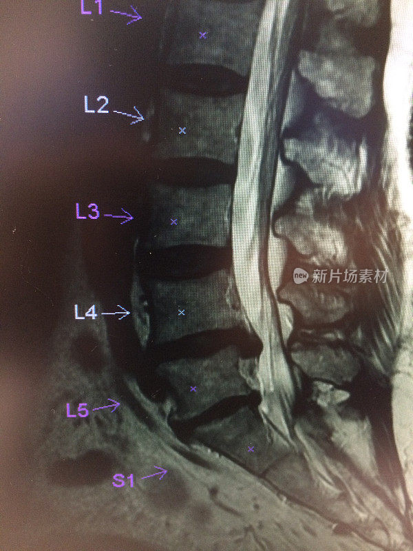 腰椎间盘突出的MRI