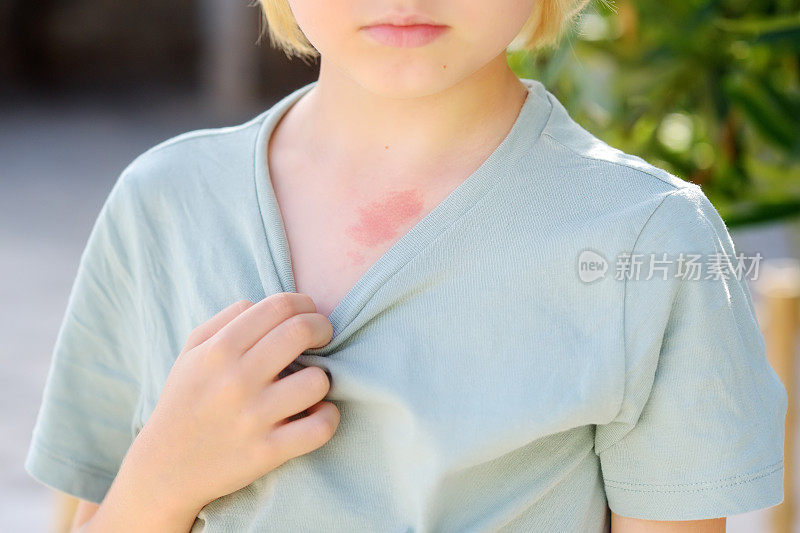 八岁小孩胸部皮肤上的记号。血管瘤是一种来自皮肤上血管的红色胎记，良性肿瘤。