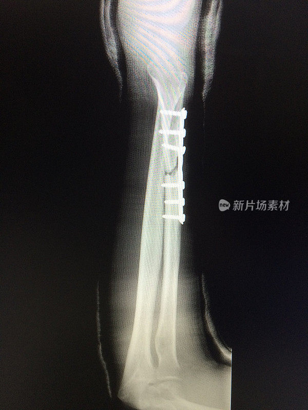 桡骨骨折不愈合的人手臂x线照片