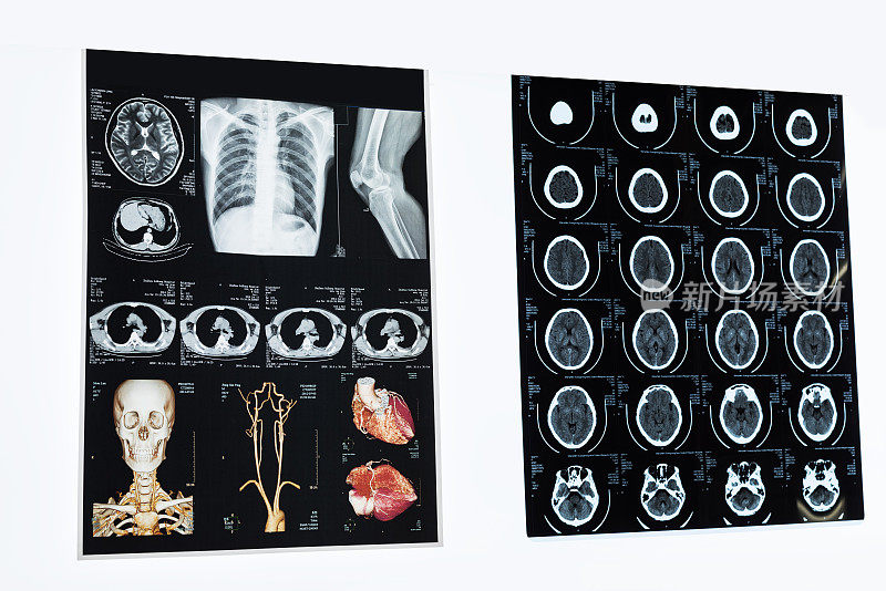 头部CT扫描片