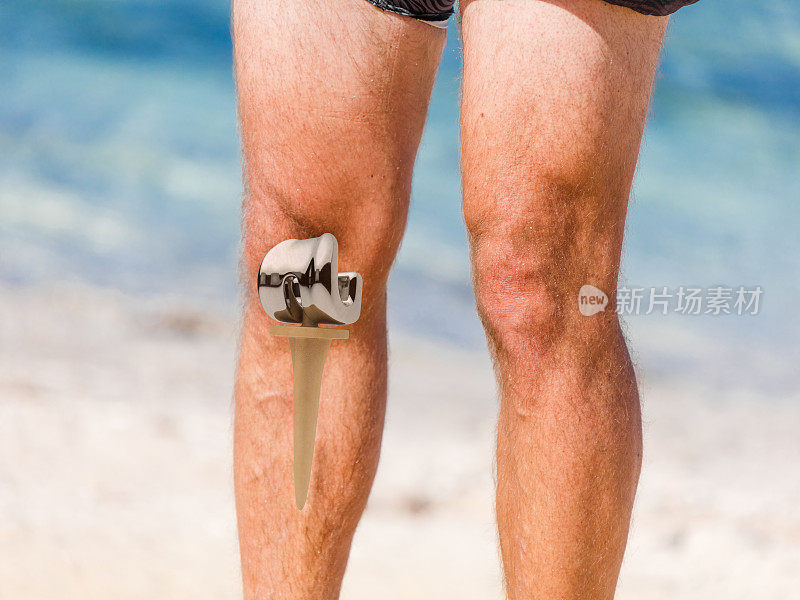 膝盖endoprosthesis