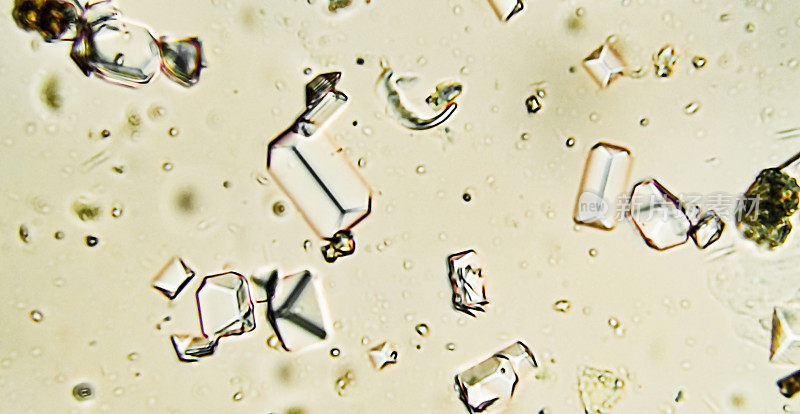 显微镜下宠物尿液中的鸟粪石晶体