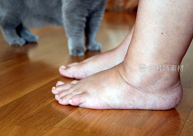 一位老妇人的脚肿了。光脚装满了水，变得很沉。背景中有一只猫毛茸茸的灰色爪子。