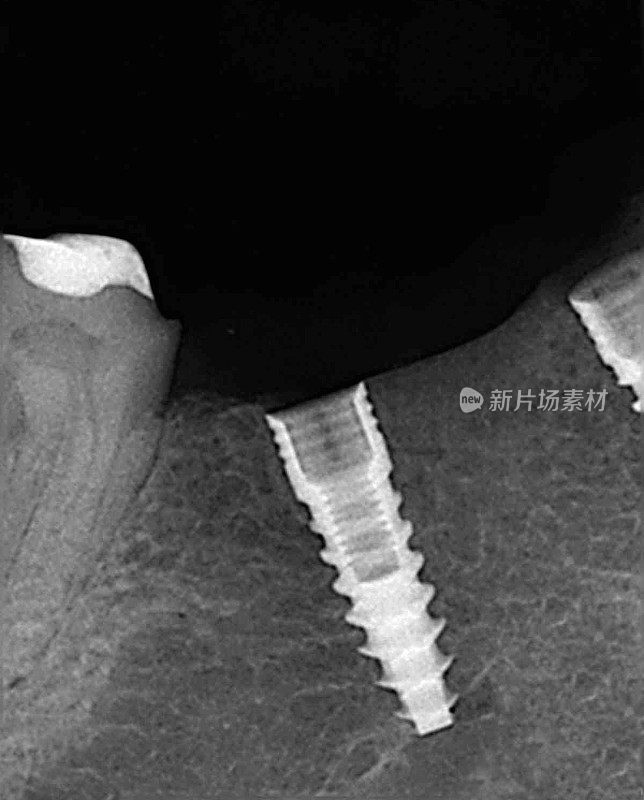 牙种植体x光片