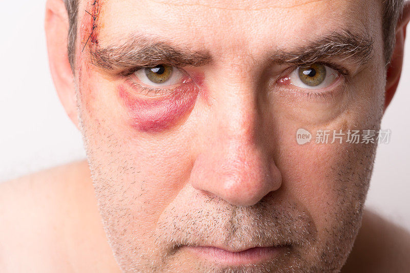 近距离伤，男子眼睛附近缝合的大伤口